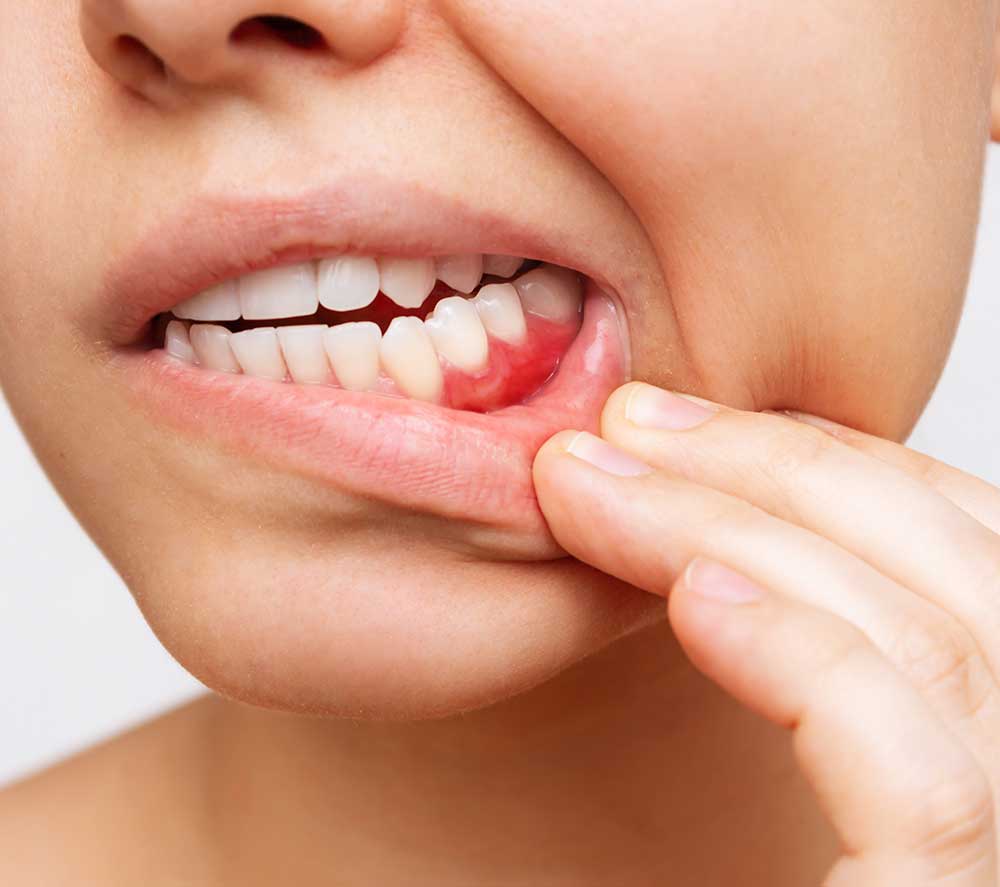 Diş Etlerindeki Kanamalar Başka Hastalıkların Habercisi Mi