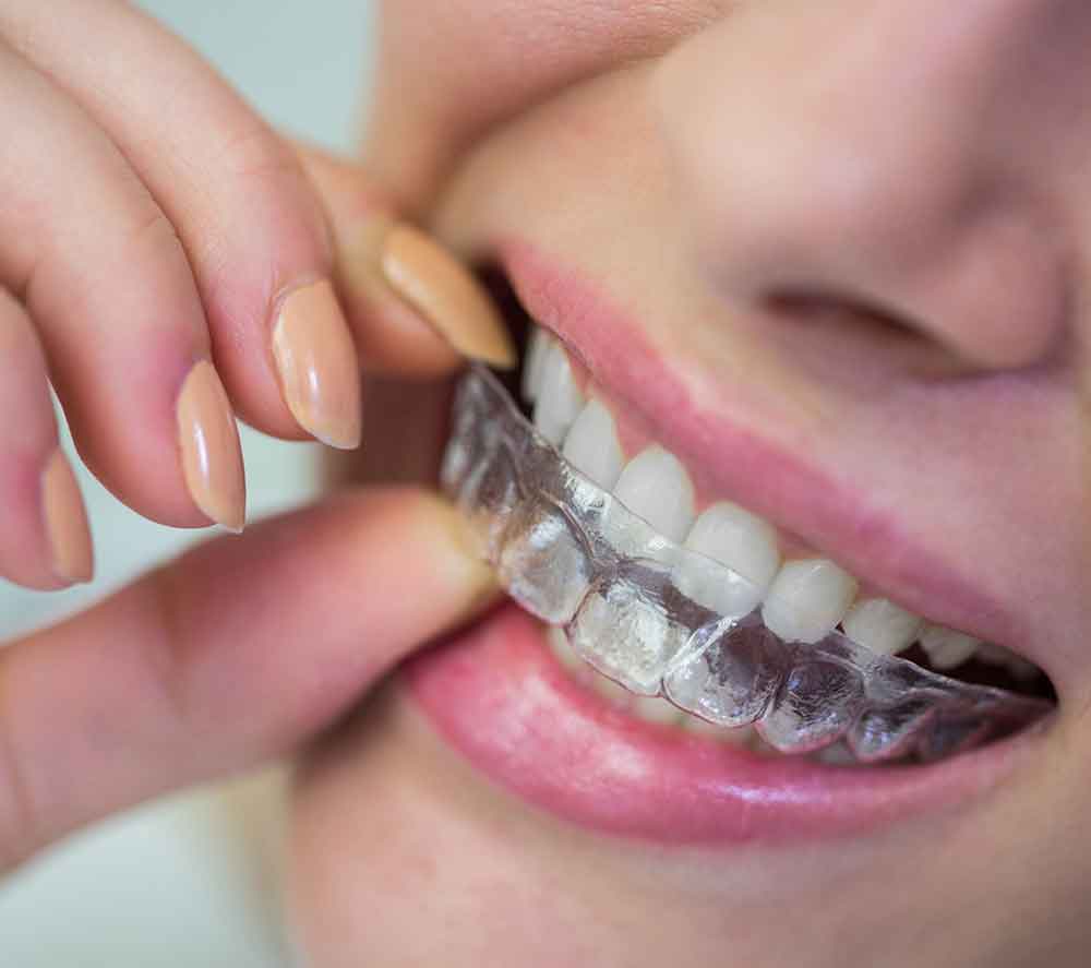 Diş Telleri ve Braketlere Veda, Şeffaf Plaklarla Daha Güzel Gülüşlere