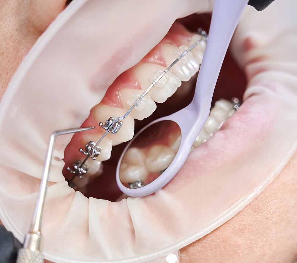 Ortodonti Tedavisinde Bilinmeyenler